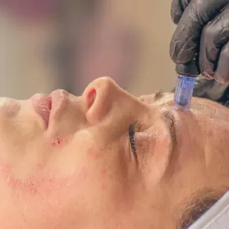 Tratamento anti manchas